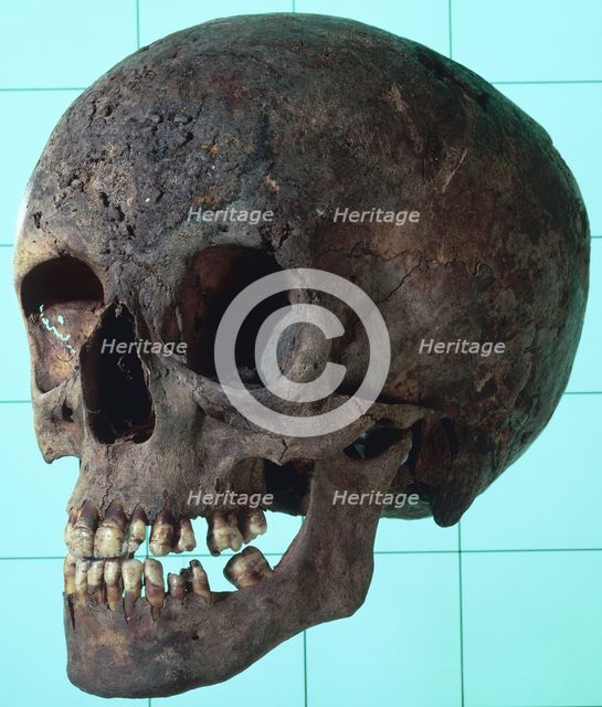 Female syphilitic skull with multiple erosive lesions. Creator: Unknown.