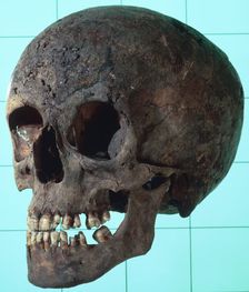 Female syphilitic skull with multiple erosive lesions. Creator: Unknown