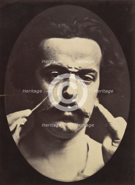 Figure 16: Expression of severity , 1854-56, printed 1862. Creators: Duchenne de Boulogne, Adrien Alban Tournachon.