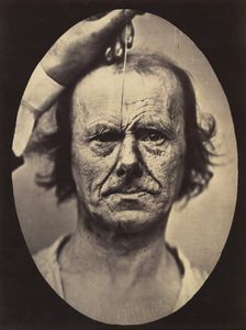 Figure 17: On the right, electrization of m. procerus: severity, aggressi..., 1854-56, printed 1862. Creators: Duchenne de Boulogne, Adrien Alban Tournachon