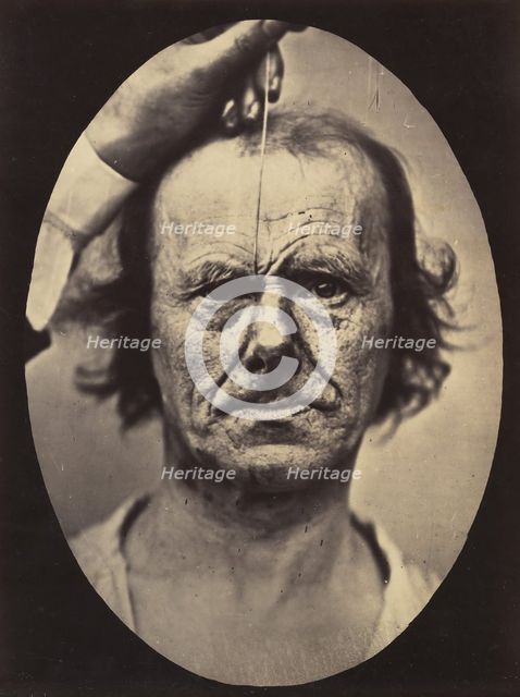 Figure 17: On the right, electrization of m. procerus: severity, aggressi..., 1854-56, printed 1862. Creators: Duchenne de Boulogne, Adrien Alban Tournachon.