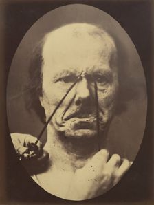 Figure 18: Aggression, wickedness, 1854-56, printed 1862. Creators: Duchenne de Boulogne, Adrien Alban Tournachon