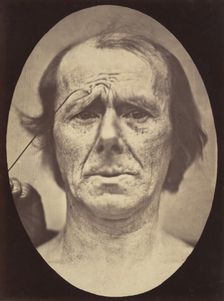 Figure 19: Suffering , 1854-56, printed 1862. Creators: Duchenne de Boulogne, Adrien Alban Tournachon