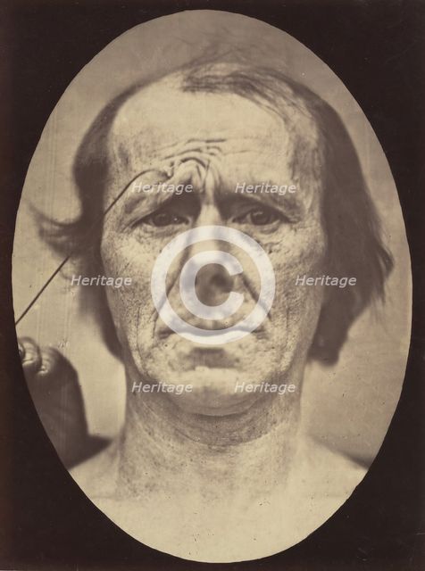 Figure 19: Suffering , 1854-56, printed 1862. Creators: Duchenne de Boulogne, Adrien Alban Tournachon.