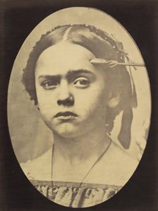 Figure 10: Showing the expressive lines of m. frontalis in a young girl , 1854-56, printed 1862. Creators: Duchenne de Boulogne, Adrien Alban Tournachon