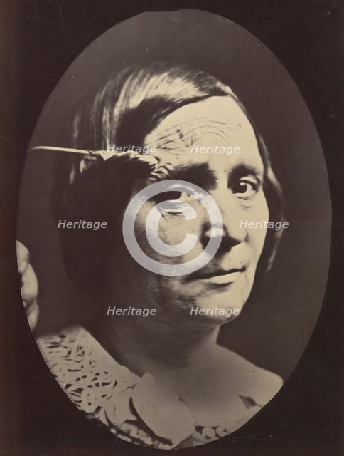 Figure 26: Expression of painful attention and attention, attentive gaze. , 1854-56, printed 1862. Creators: Duchenne de Boulogne, Adrien Alban Tournachon.