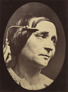 Figure 27: Expression proportionally more pained, 1854-56, printed 1862. Creators: Duchenne de Boulogne, Adrien Alban Tournachon