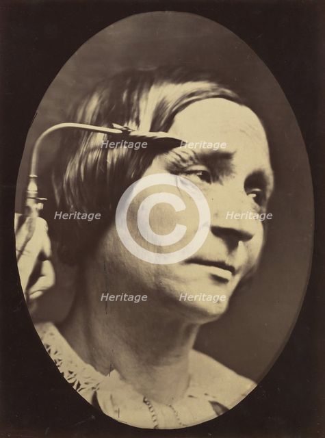 Figure 27: Expression proportionally more pained, 1854-56, printed 1862. Creators: Duchenne de Boulogne, Adrien Alban Tournachon.