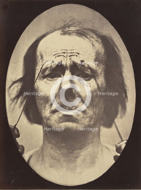 Figure 20: Profound suffering, with resignation, 1854-56, printed 1862. Creators: Duchenne de Boulogne, Adrien Alban Tournachon.