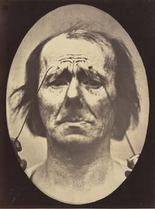 Figure 20: Profound suffering, with resignation, 1854-56, printed 1862. Creators: Duchenne de Boulogne, Adrien Alban Tournachon