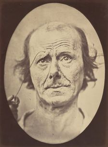 Figure 21: Painful recollection and recollection or calling something to ..., 1854-56, printed 1862. Creators: Duchenne de Boulogne, Adrien Alban Tournachon
