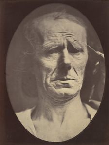Figure 22: No painful expression , 1854-56, printed 1862. Creators: Duchenne de Boulogne, Adrien Alban Tournachon