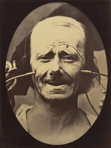Figure 34: Grimace, 1854-56, printed 1862. Creators: Duchenne de Boulogne, Adrien Alban Tournachon