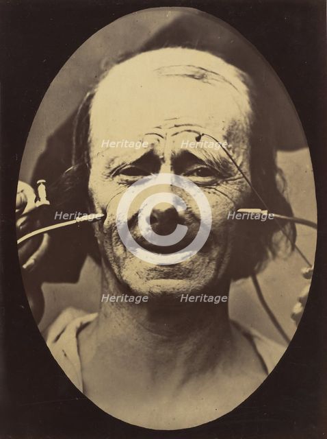 Figure 34: Grimace, 1854-56, printed 1862. Creators: Duchenne de Boulogne, Adrien Alban Tournachon.