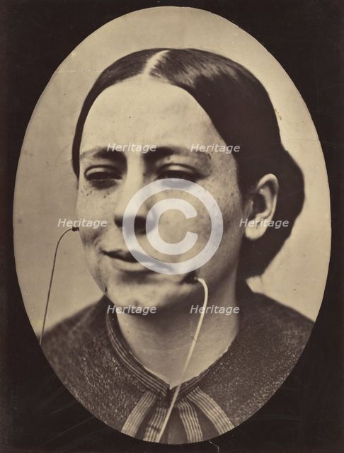 Figure 36: Scornful laughter and scornful disgust, 1854-56, printed 1862. Creators: Duchenne de Boulogne, Adrien Alban Tournachon.