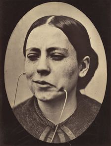 Figure 36: Scornful laughter and scornful disgust, 1854-56, printed 1862. Creators: Duchenne de Boulogne, Adrien Alban Tournachon