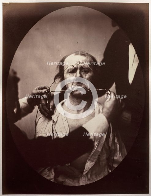 Figure 45: Contraction électrique forte des triangulaires des lèvres et des sourciliers:..., c. 1856 Creator: Guillaume-Benjamin-Amand Duchenne (de Boulogne) (French, 1806-1875); Adrien Tournachon (French, 1825-1903).