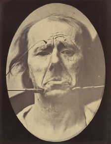 Figure 45: Pain and despair. , 1854-56, printed 1862. Creators: Duchenne de Boulogne, Adrien Alban Tournachon