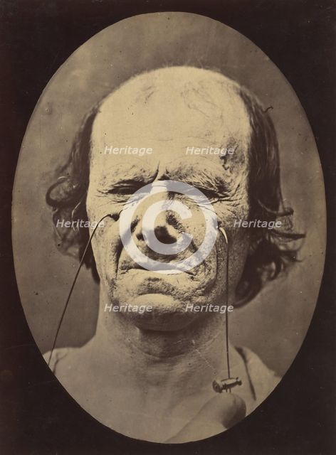 Figure 47: A suggestion of this same weeping, 1854-56, printed 1862. Creators: Duchenne de Boulogne, Adrien Alban Tournachon.