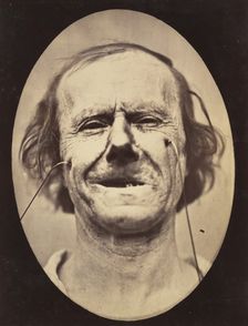 Figure 48: Mild weeping, pity and feeble false laughter , 1854-56, printed 1862. Creators: Duchenne de Boulogne, Adrien Alban Tournachon