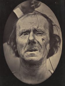Figure 49: Painful weeping and forward looking., 1854-56, printed 1862. Creators: Duchenne de Boulogne, Adrien Alban Tournachon