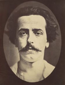 Figure 4: The face in repose of a young man , 1854-56, printed 1862. Creators: Duchenne de Boulogne, Adrien Alban Tournachon