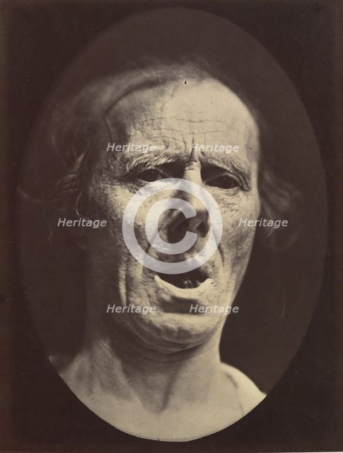 Figure 54: Voluntary lowering of the lower jaw, 1854-56, printed 1862. Creators: Duchenne de Boulogne, Adrien Alban Tournachon.