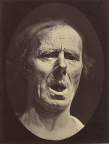 Figure 54: Voluntary lowering of the lower jaw, 1854-56, printed 1862. Creators: Duchenne de Boulogne, Adrien Alban Tournachon