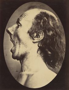 Figure 55: Astonishment badly rendered by the subject: a ridiculous and i..., 1854-56, printed 1862. Creators: Duchenne de Boulogne, Adrien Alban Tournachon
