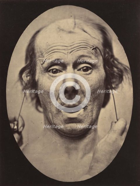 Figure 56: Surprise, 1854-56, printed 1862. Creators: Duchenne de Boulogne, Adrien Alban Tournachon.