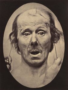 Figure 56: Surprise, 1854-56, printed 1862. Creators: Duchenne de Boulogne, Adrien Alban Tournachon