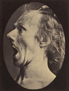 Figure 57: Astonishment, stupefaction, amazement, 1854-56, printed 1862. Creators: Duchenne de Boulogne, Adrien Alban Tournachon