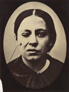 Figure 50: Affected weeping and face in repose, 1854-56, printed 1862. Creators: Duchenne de Boulogne, Adrien Alban Tournachon