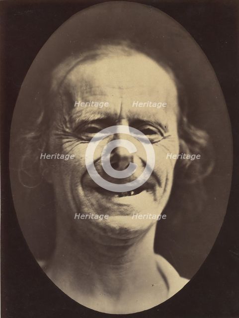 Figure 52: Voluntary retraction of the lower lip, 1854-56, printed 1862. Creators: Duchenne de Boulogne, Adrien Alban Tournachon.