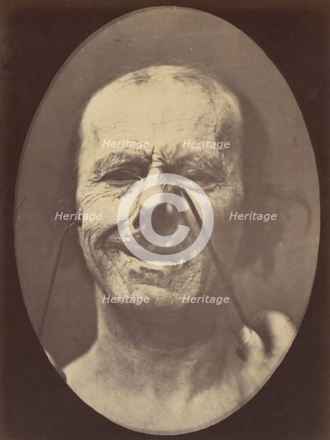 Figure 53: Whimpering and false laughter, 1854-56, printed 1862. Creators: Duchenne de Boulogne, Adrien Alban Tournachon.