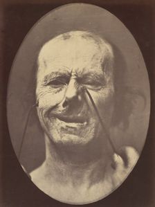 Figure 53: Whimpering and false laughter, 1854-56, printed 1862. Creators: Duchenne de Boulogne, Adrien Alban Tournachon