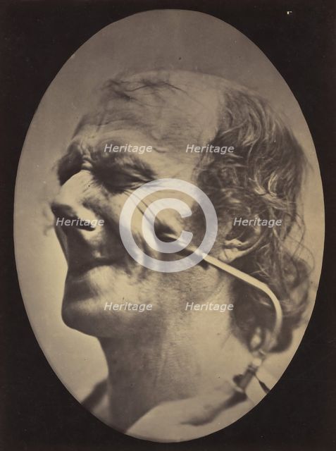 Figure 6: The grimace produced is similar to a tic of the face , 1854-56, printed 1862. Creators: Duchenne de Boulogne, Adrien Alban Tournachon.