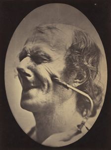 Figure 6: The grimace produced is similar to a tic of the face , 1854-56, printed 1862. Creators: Duchenne de Boulogne, Adrien Alban Tournachon