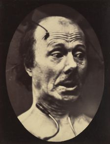 Figure 60: Fright, 1854-56, printed 1862. Creators: Duchenne de Boulogne, Adrien Alban Tournachon