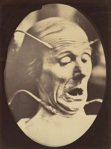 Figure 62: Terror, semiprofile, 1854-56, printed 1862. Creators: Duchenne de Boulogne, Adrien Alban Tournachon