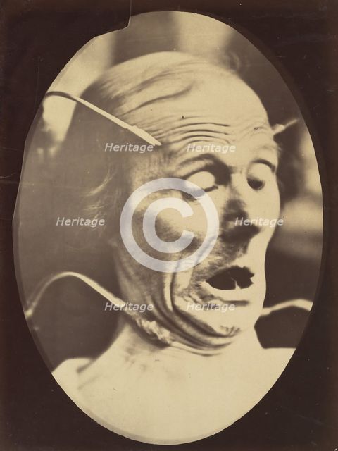 Figure 62: Terror, semiprofile, 1854-56, printed 1862. Creators: Duchenne de Boulogne, Adrien Alban Tournachon.