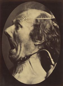 Figure 63: Expression of terror, 1854-56, printed 1862. Creators: Duchenne de Boulogne, Adrien Alban Tournachon