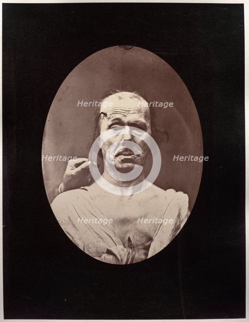Figure 7: Étude du méchanisme et de lexpression du muscle frontal chez un vieillard: à droit..., c.  Creator: Guillaume-Benjamin-Amand Duchenne (de Boulogne) (French, 1806-1875); Adrien Tournachon (French, 1825-1903).