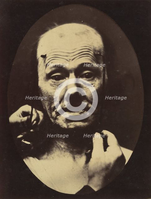 Figure 8: Contraction of the right m. frontalis. , 1854-56, printed 1862. Creators: Duchenne de Boulogne, Adrien Alban Tournachon.
