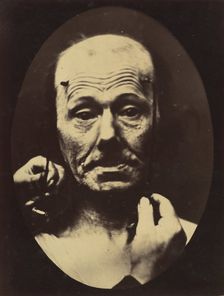 Figure 8: Contraction of the right m. frontalis. , 1854-56, printed 1862. Creators: Duchenne de Boulogne, Adrien Alban Tournachon