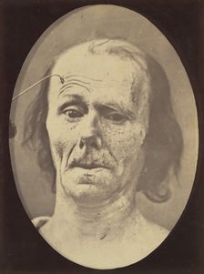 Figure 9: A study of m. frontalis in maximum contraction, 1854-56, printed 1862. Creators: Duchenne de Boulogne, Adrien Alban Tournachon