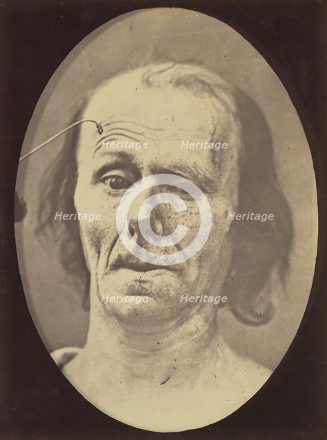 Figure 9: A study of m. frontalis in maximum contraction, 1854-56, printed 1862. Creators: Duchenne de Boulogne, Adrien Alban Tournachon.