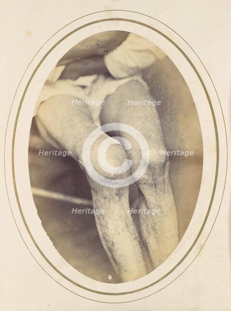 Frederick Hohmann, 1865. Creator: Reed Brockway Bontecou.