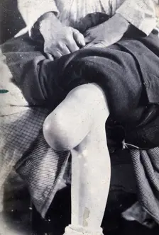 Friern Hospital, London: the knee of a seated person, with a large growth, 1890-1910. Creator: Unknown