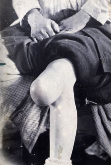Friern Hospital, London: the knee of a seated person, with a large growth, 1890-1910. Creator: Unknown